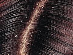 Closeup of parted hair with dandruff on it.
